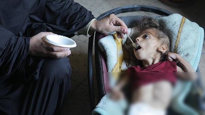 গাজায় দুর্ভিক্ষ, অনাহার, লাশের স্তূপ by মোহাম্মদ আবুল হোসেন