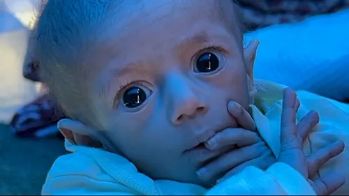 গাজায় ইসরায়েলি অবরোধে খাদ্যের অভাবে কঙ্কালসার শিশু সিওয়ার